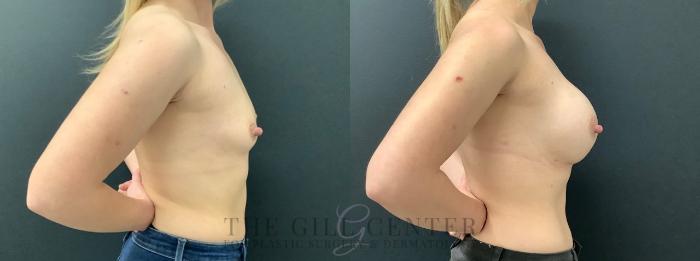 Breast Augmentation Case 600 Before & After Right Side | The Woodlands, TX | The Gill Center for Plastic Surgery and Dermatology