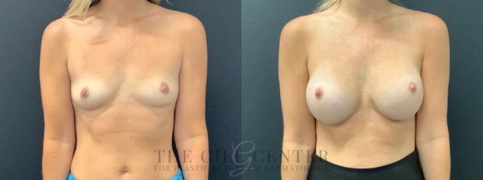Breast Augmentation Case 601 Before & After Front | The Woodlands, TX | The Gill Center for Plastic Surgery and Dermatology