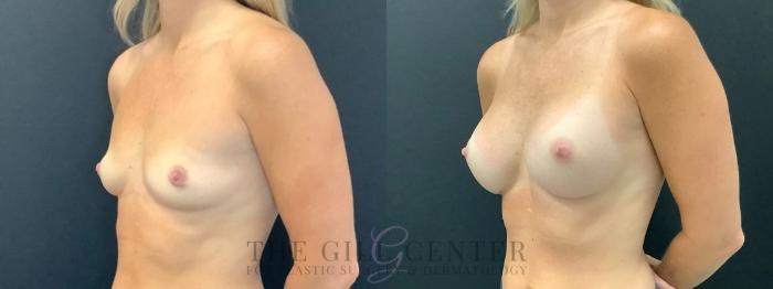 Breast Augmentation Case 601 Before & After Left Oblique | The Woodlands, TX | The Gill Center for Plastic Surgery and Dermatology