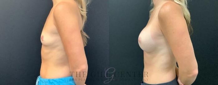 Breast Augmentation Case 601 Before & After Left Side | The Woodlands, TX | The Gill Center for Plastic Surgery and Dermatology