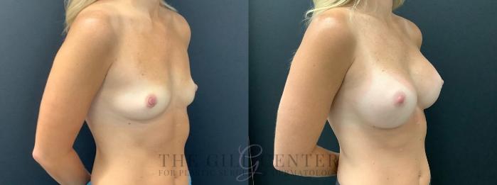 Breast Augmentation Case 601 Before & After Right Oblique | The Woodlands, TX | The Gill Center for Plastic Surgery and Dermatology