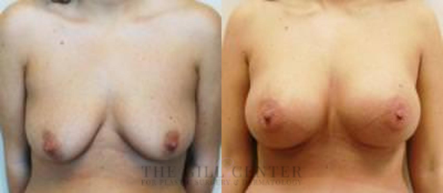 Breast Augmentation Case 63 Before & After Front | The Woodlands, TX | The Gill Center for Plastic Surgery and Dermatology
