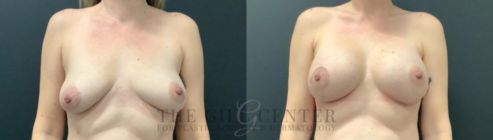 Breast Augmentation Case 632 Before & After Front | The Woodlands, TX | The Gill Center for Plastic Surgery and Dermatology