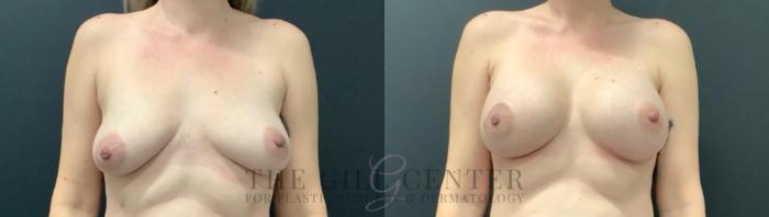Breast Augmentation Case 632 Before & After Front | The Woodlands, TX | The Gill Center for Plastic Surgery and Dermatology