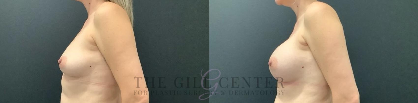 Breast Augmentation Case 632 Before & After Left Side | The Woodlands, TX | The Gill Center for Plastic Surgery and Dermatology