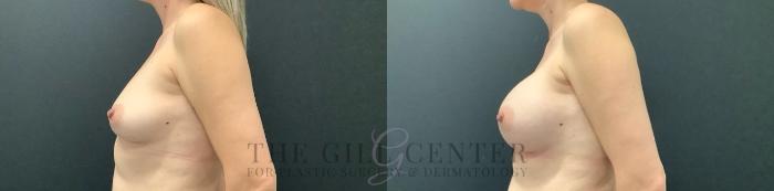 Breast Augmentation Case 632 Before & After Left Side | The Woodlands, TX | The Gill Center for Plastic Surgery and Dermatology