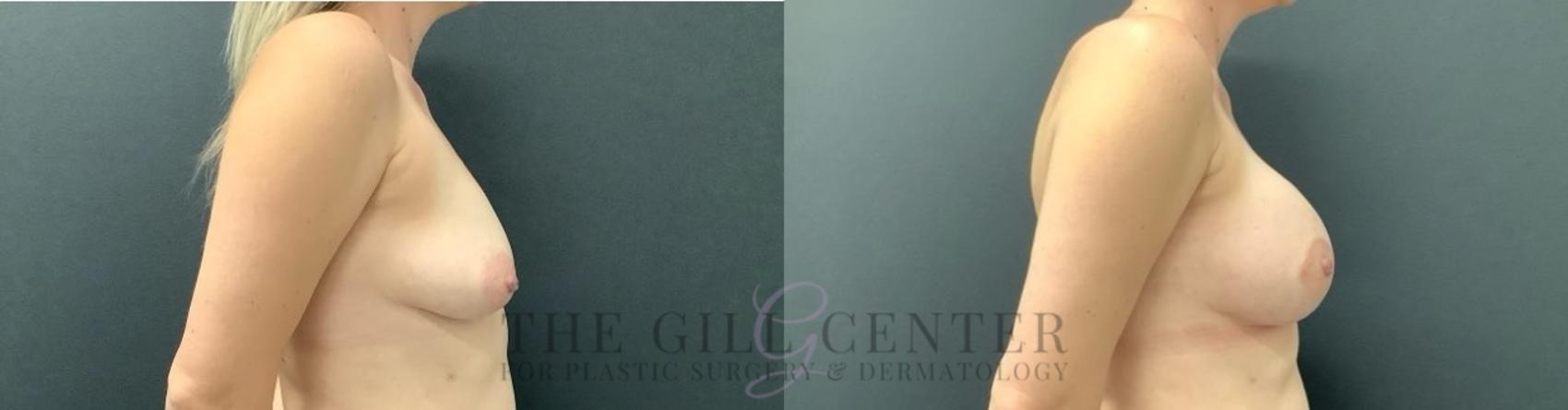 Breast Augmentation Case 632 Before & After Right Side | The Woodlands, TX | The Gill Center for Plastic Surgery and Dermatology