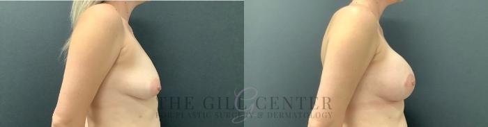 Breast Augmentation Case 632 Before & After Right Side | The Woodlands, TX | The Gill Center for Plastic Surgery and Dermatology