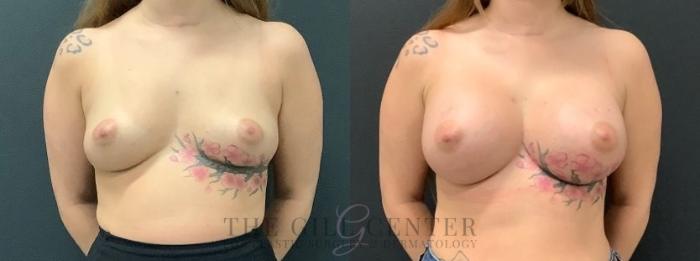 Breast Augmentation Case 645 Before & After Front | The Woodlands, TX | The Gill Center for Plastic Surgery and Dermatology