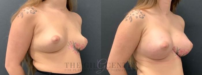 Breast Augmentation Case 645 Before & After Right Oblique | The Woodlands, TX | The Gill Center for Plastic Surgery and Dermatology