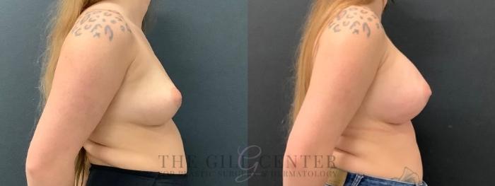 Breast Augmentation Case 645 Before & After Right Side | The Woodlands, TX | The Gill Center for Plastic Surgery and Dermatology
