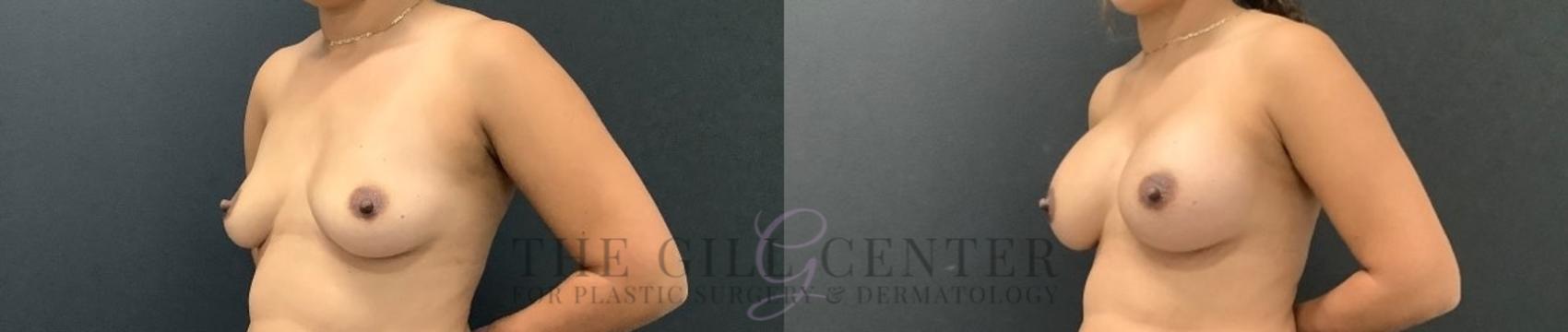 Breast Augmentation Case 646 Before & After Left Oblique | The Woodlands, TX | The Gill Center for Plastic Surgery and Dermatology