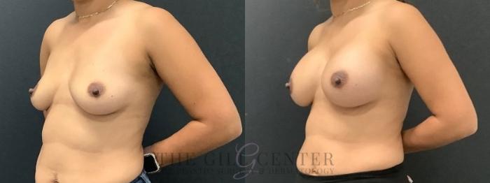 Breast Augmentation Case 646 Before & After Left Oblique | The Woodlands, TX | The Gill Center for Plastic Surgery and Dermatology
