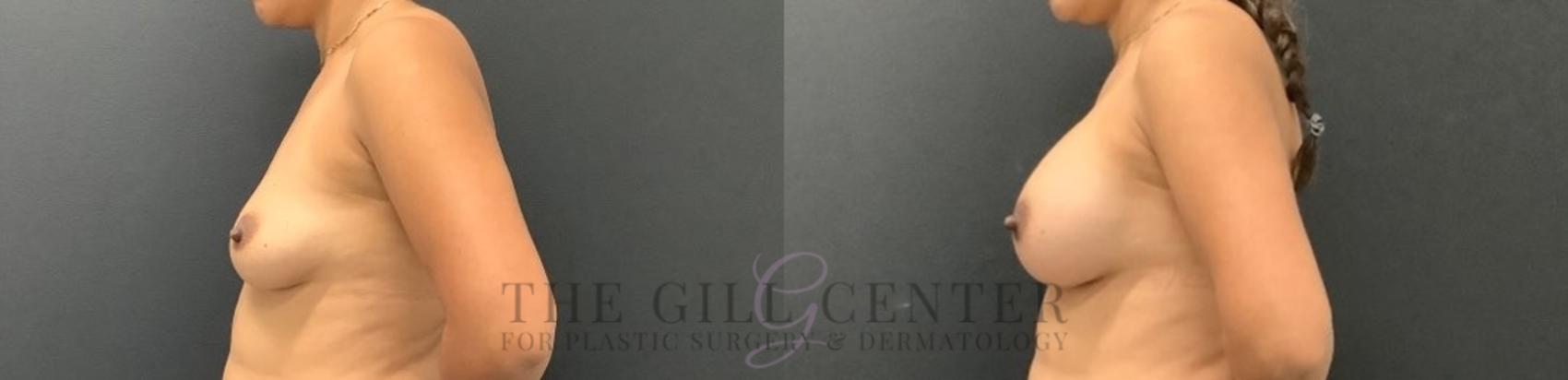 Breast Augmentation Case 646 Before & After Left Side | The Woodlands, TX | The Gill Center for Plastic Surgery and Dermatology