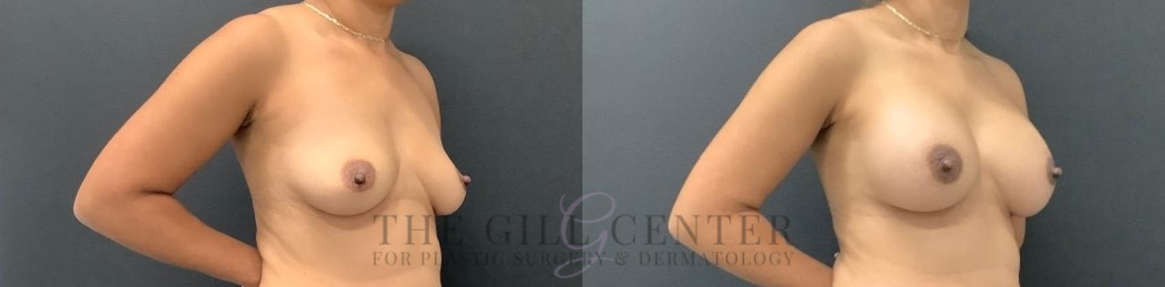 Breast Augmentation Case 646 Before & After Right Oblique | The Woodlands, TX | The Gill Center for Plastic Surgery and Dermatology