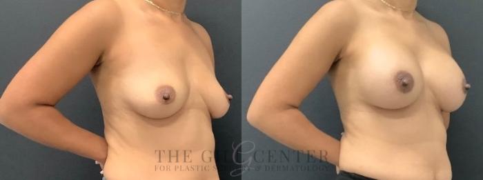 Breast Augmentation Case 646 Before & After Right Oblique | The Woodlands, TX | The Gill Center for Plastic Surgery and Dermatology