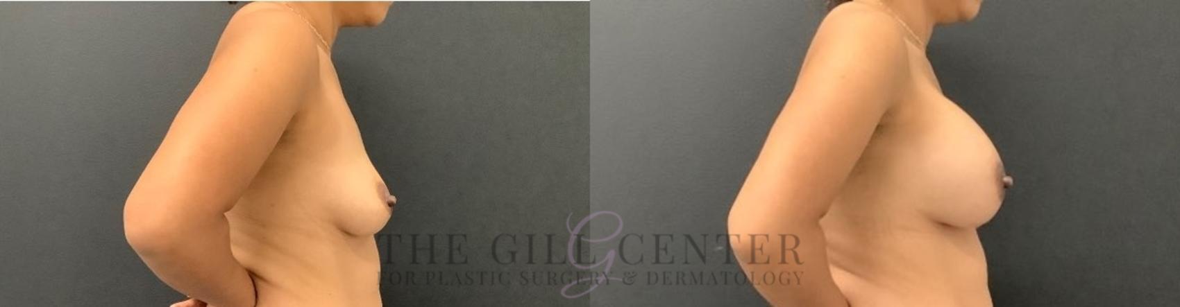 Breast Augmentation Case 646 Before & After Right Side | The Woodlands, TX | The Gill Center for Plastic Surgery and Dermatology