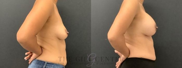 Breast Augmentation Case 646 Before & After Right Side | The Woodlands, TX | The Gill Center for Plastic Surgery and Dermatology