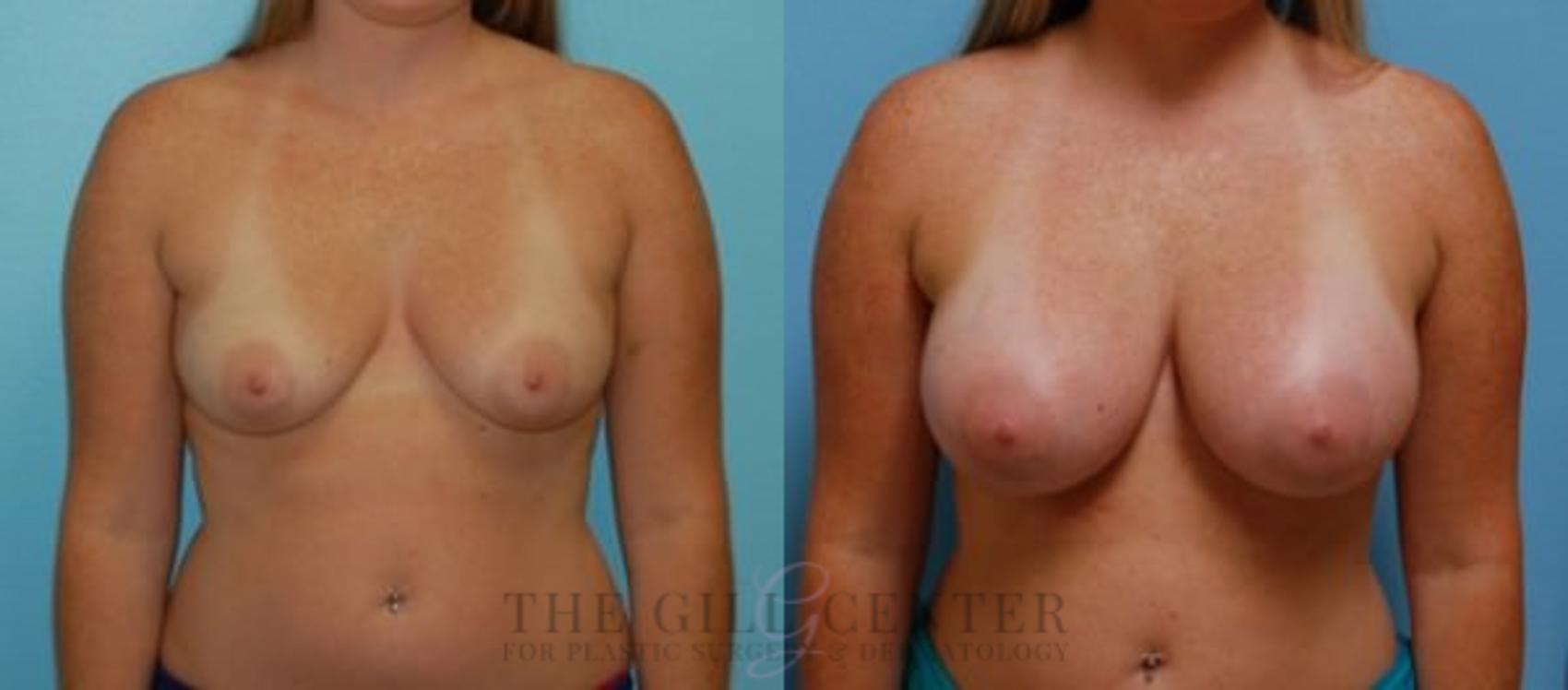 Breast Augmentation Case 66 Before & After Front | The Woodlands, TX | The Gill Center for Plastic Surgery and Dermatology