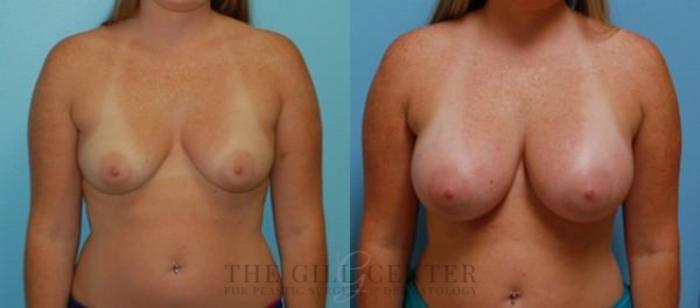 Breast Augmentation Case 66 Before & After Front | The Woodlands, TX | The Gill Center for Plastic Surgery and Dermatology