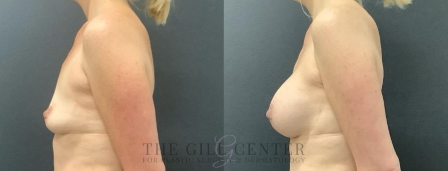Breast Augmentation Case 680 Before & After Left | The Woodlands, TX | The Gill Center for Plastic Surgery and Dermatology