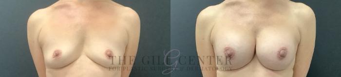 Breast Augmentation Case 680 Before & After Left Side | The Woodlands, TX | The Gill Center for Plastic Surgery and Dermatology