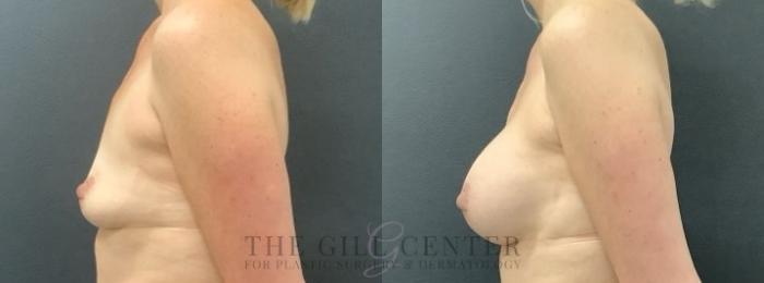 Breast Augmentation Case 680 Before & After Left | The Woodlands, TX | The Gill Center for Plastic Surgery and Dermatology