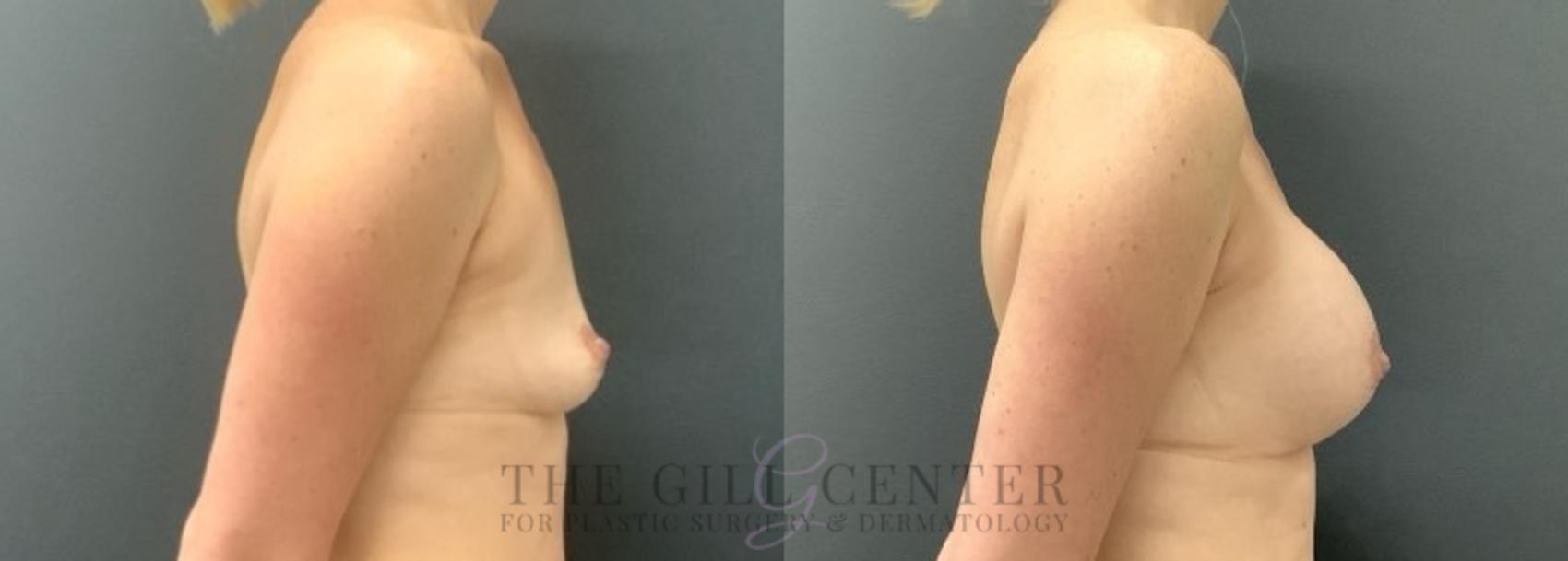 Breast Augmentation Case 680 Before & After Right Side | The Woodlands, TX | The Gill Center for Plastic Surgery and Dermatology