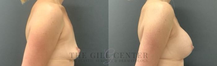 Breast Augmentation Case 680 Before & After Right Side | The Woodlands, TX | The Gill Center for Plastic Surgery and Dermatology