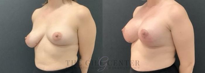 Breast Augmentation Case 682 Before & After Left Oblique | The Woodlands, TX | The Gill Center for Plastic Surgery and Dermatology
