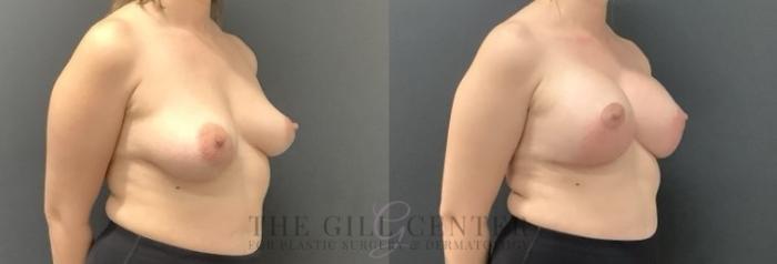 Breast Augmentation Case 682 Before & After Right Oblique | The Woodlands, TX | The Gill Center for Plastic Surgery and Dermatology