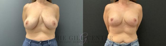 Breast Augmentation Case 688 Before & After Front | The Woodlands, TX | The Gill Center for Plastic Surgery and Dermatology