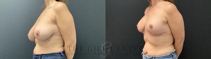 Breast Augmentation Case 688 Before & After Left Side | The Woodlands, TX | The Gill Center for Plastic Surgery and Dermatology