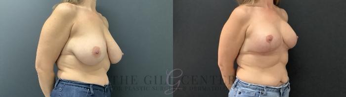 Breast Augmentation Case 688 Before & After Right Side | The Woodlands, TX | The Gill Center for Plastic Surgery and Dermatology