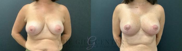 Breast Augmentation Case 693 Before & After Front | The Woodlands, TX | The Gill Center for Plastic Surgery and Dermatology