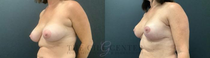 Breast Augmentation Case 693 Before & After Left Side | The Woodlands, TX | The Gill Center for Plastic Surgery and Dermatology