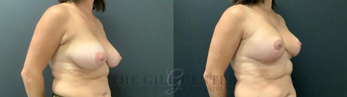 Breast Augmentation Case 693 Before & After Right Side | The Woodlands, TX | The Gill Center for Plastic Surgery and Dermatology