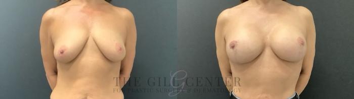 Breast Augmentation Case 695 Before & After Front | The Woodlands, TX | The Gill Center for Plastic Surgery and Dermatology