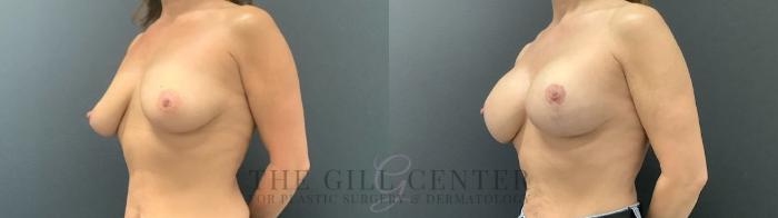 Breast Augmentation Case 695 Before & After Left Side | The Woodlands, TX | The Gill Center for Plastic Surgery and Dermatology