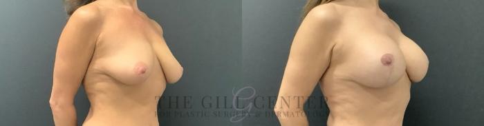 Breast Augmentation Case 695 Before & After Right Side | The Woodlands, TX | The Gill Center for Plastic Surgery and Dermatology