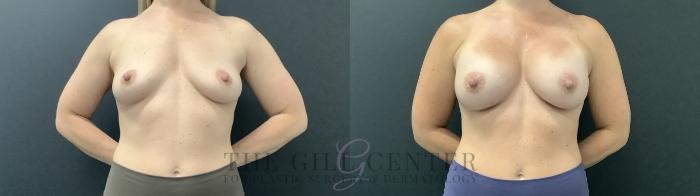 Breast Augmentation Case 704 Before & After Front | The Woodlands, TX | The Gill Center for Plastic Surgery and Dermatology