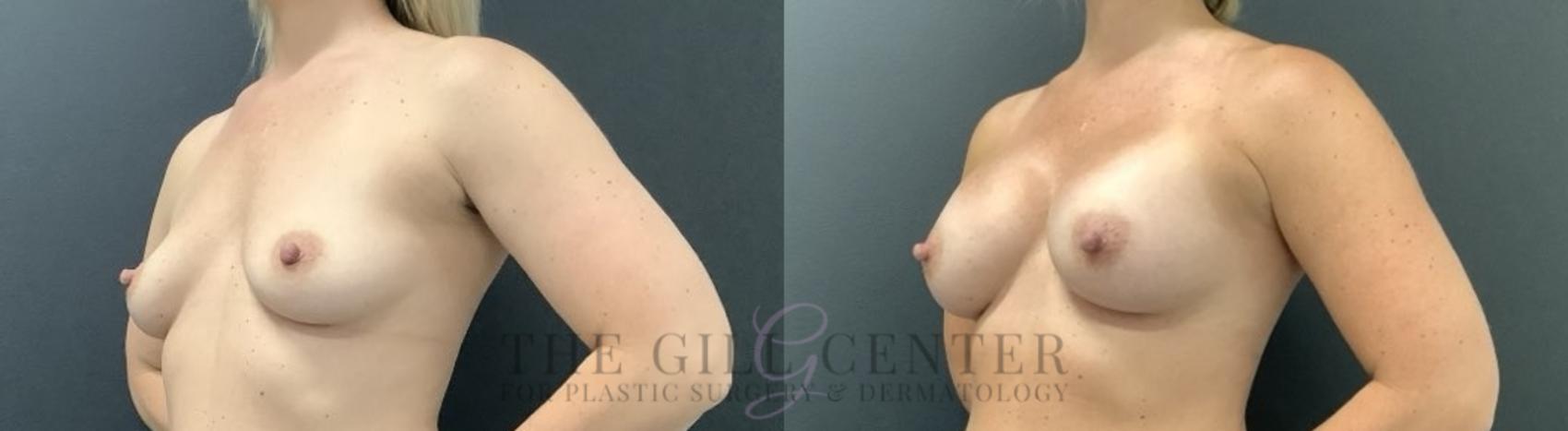 Breast Augmentation Case 704 Before & After Left Side | The Woodlands, TX | The Gill Center for Plastic Surgery and Dermatology