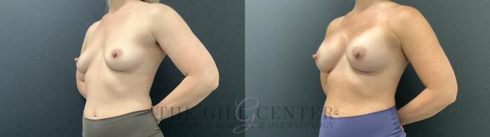 Breast Augmentation Case 704 Before & After Left Side | The Woodlands, TX | The Gill Center for Plastic Surgery and Dermatology