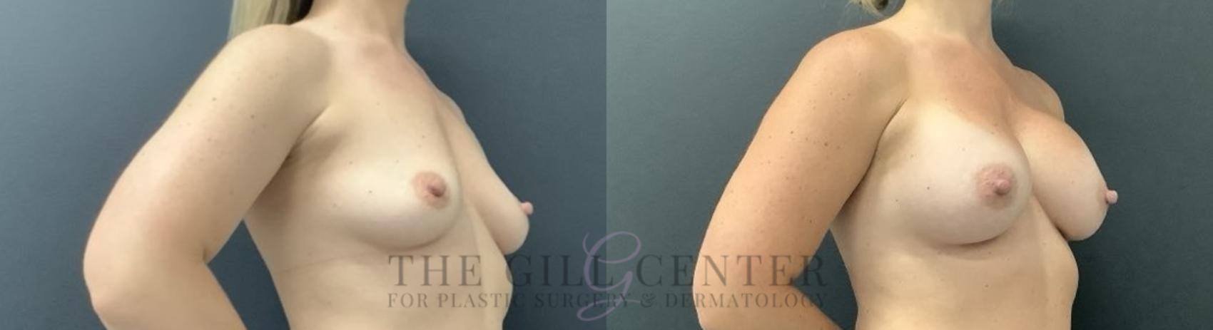 Breast Augmentation Case 704 Before & After Right Side | The Woodlands, TX | The Gill Center for Plastic Surgery and Dermatology