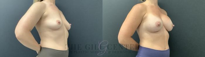 Breast Augmentation Case 704 Before & After Right Side | The Woodlands, TX | The Gill Center for Plastic Surgery and Dermatology