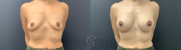 Breast Augmentation Case 706 Before & After Front | The Woodlands, TX | The Gill Center for Plastic Surgery and Dermatology