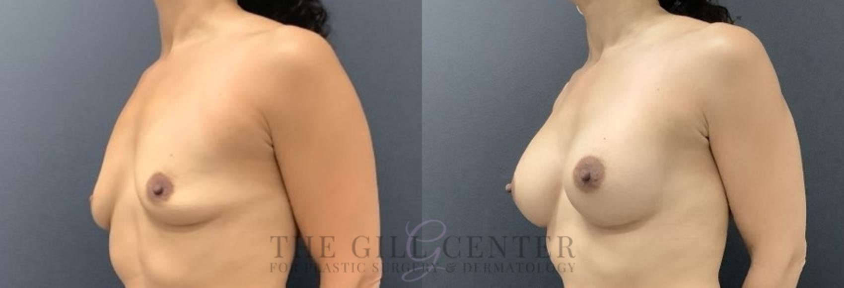 Breast Augmentation Case 706 Before & After Left Side | The Woodlands, TX | The Gill Center for Plastic Surgery and Dermatology