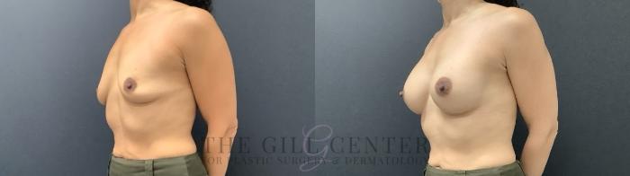 Breast Augmentation Case 706 Before & After Left Side | The Woodlands, TX | The Gill Center for Plastic Surgery and Dermatology