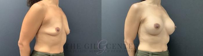 Breast Augmentation Case 706 Before & After Right Side | The Woodlands, TX | The Gill Center for Plastic Surgery and Dermatology