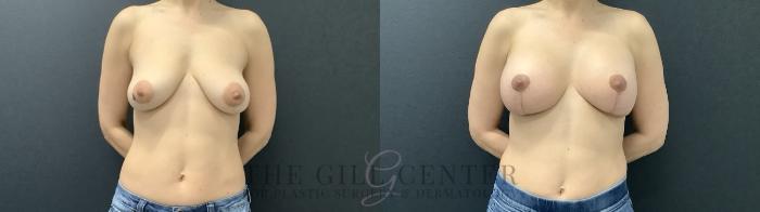 Breast Augmentation Case 707 Before & After Front | The Woodlands, TX | The Gill Center for Plastic Surgery and Dermatology
